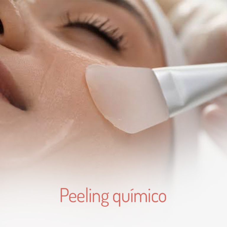 Peeling-químico-